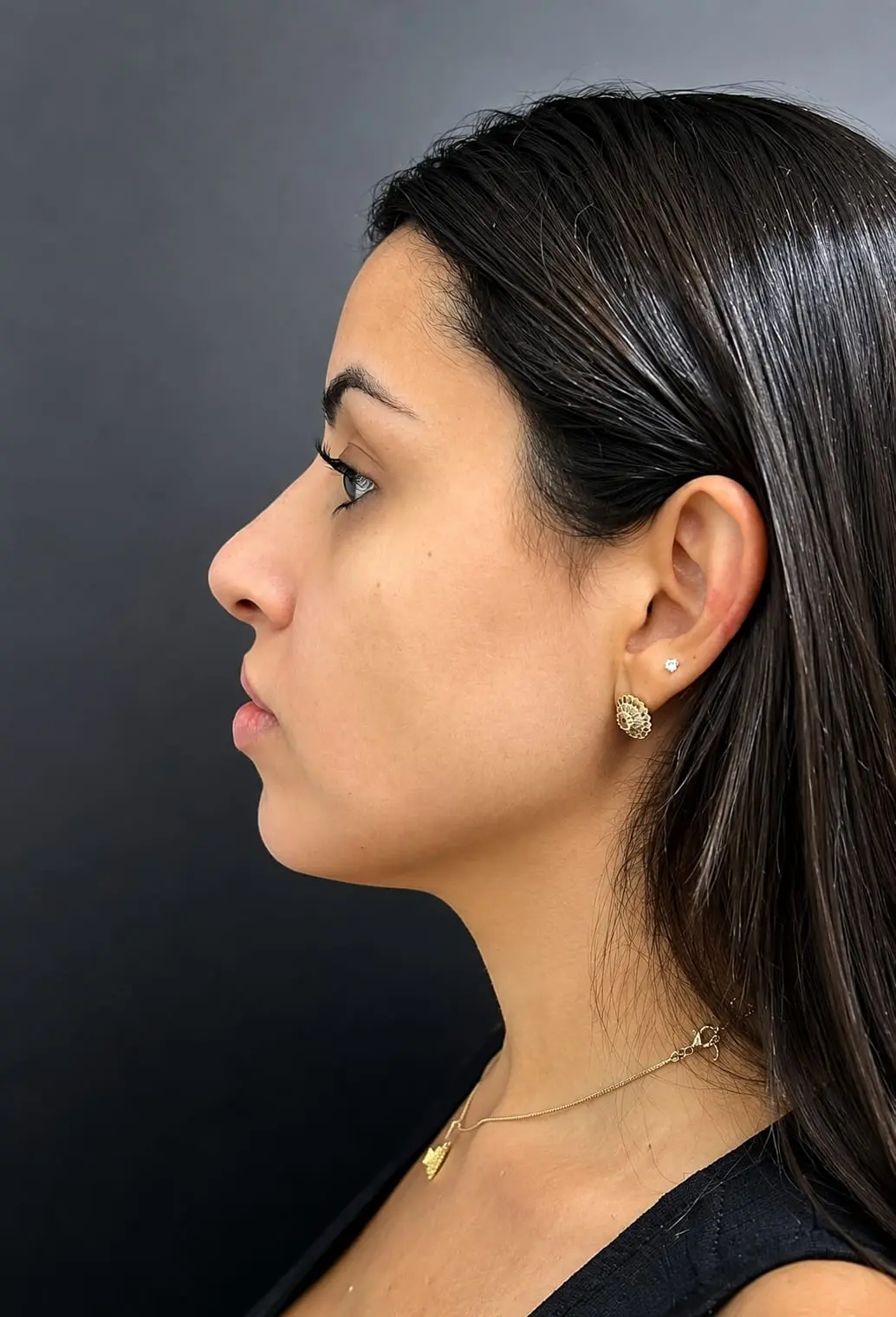 Preenchimento Facial — tratamento estético em Santana, São Paulo